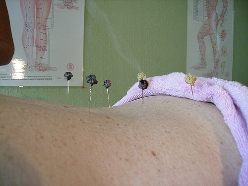 acupuncture for weight loss